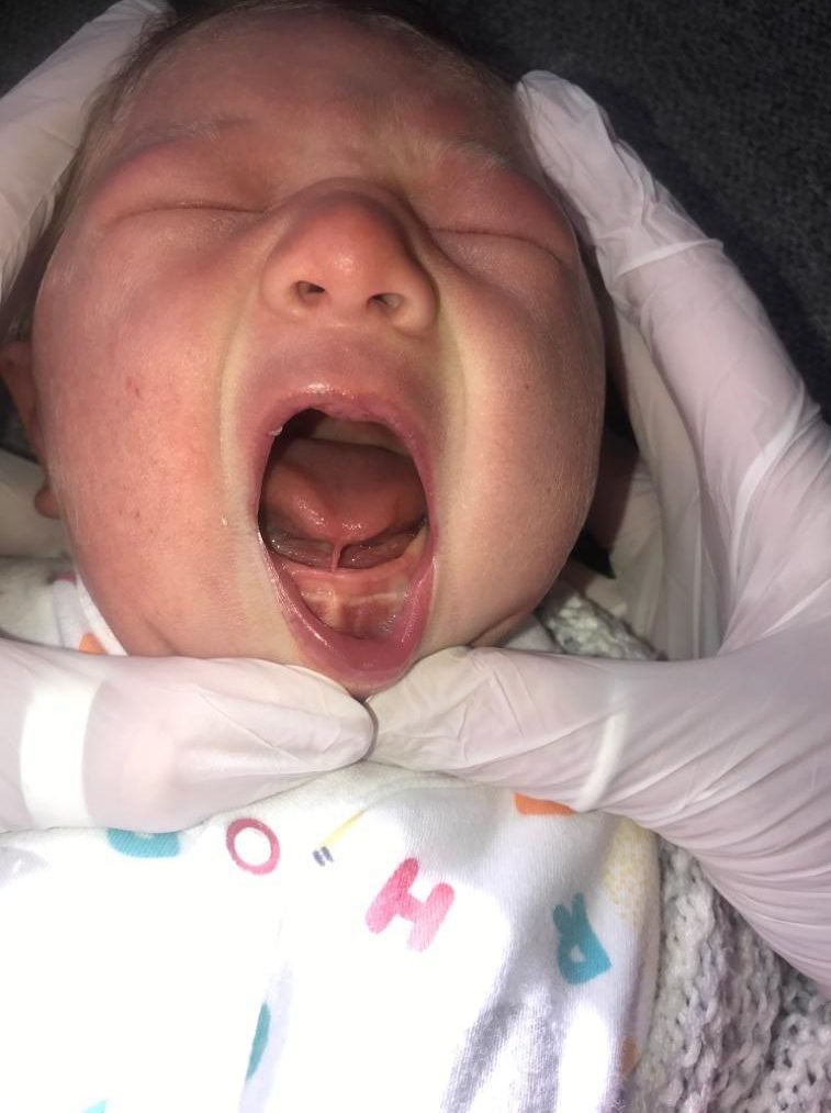 Tongue-tie baby