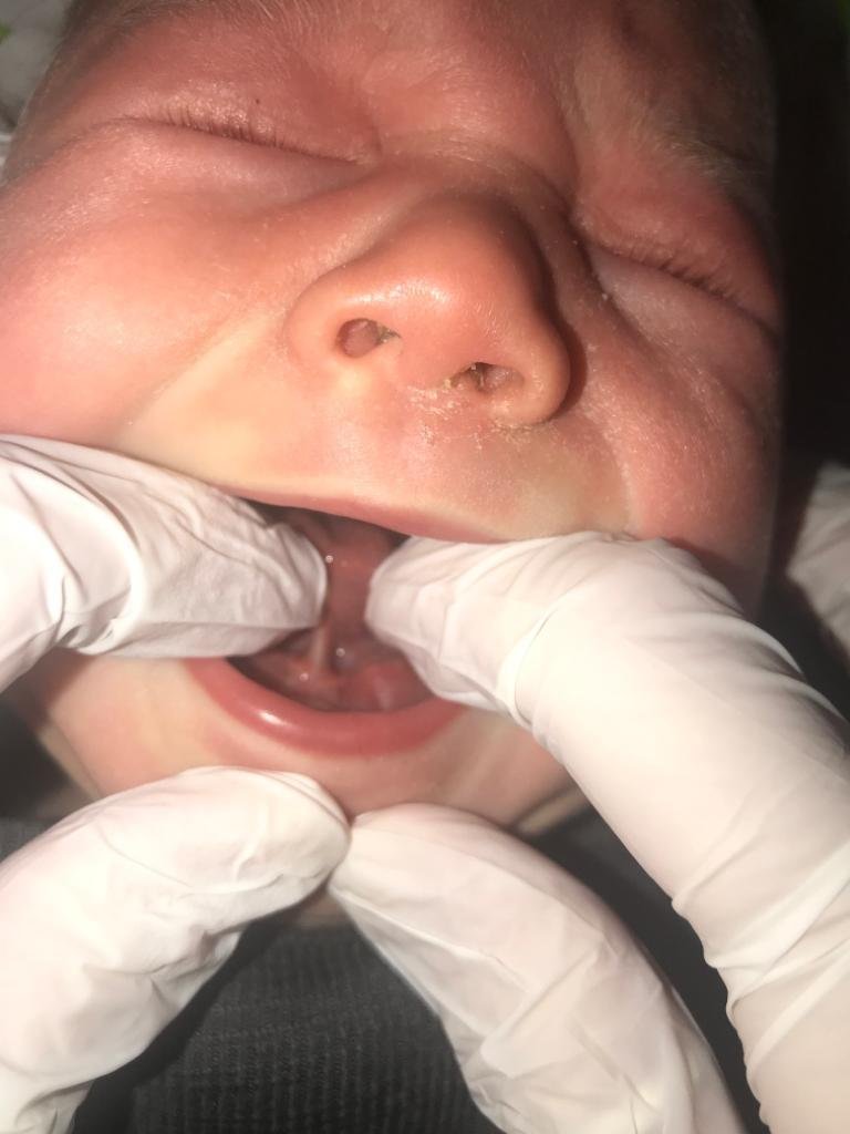 Tongue-tie baby