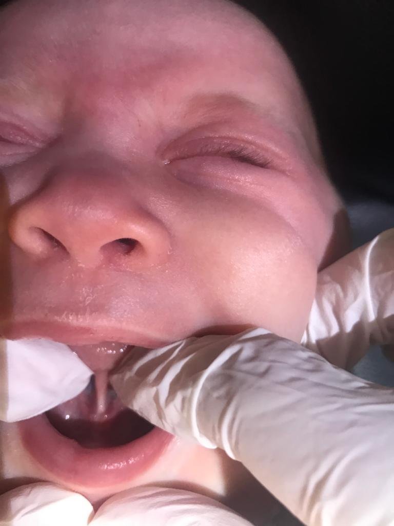 Tongue-tie baby